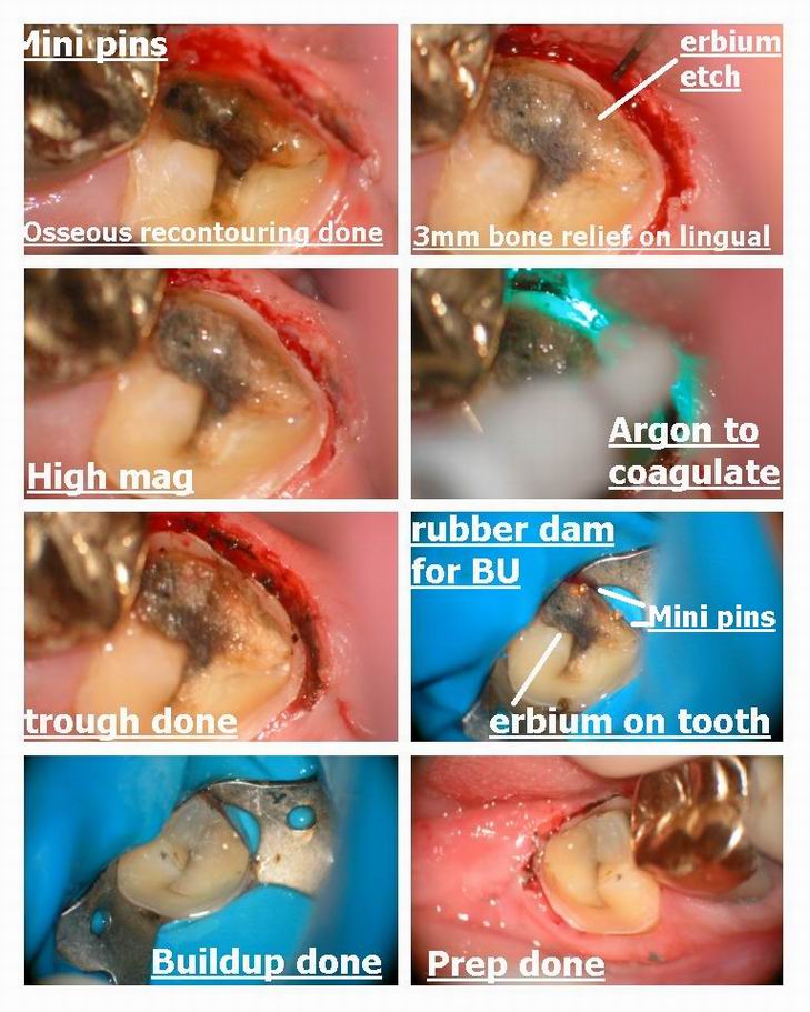 Resize of Fractured tooth osseous recontouring pg 2.jpg